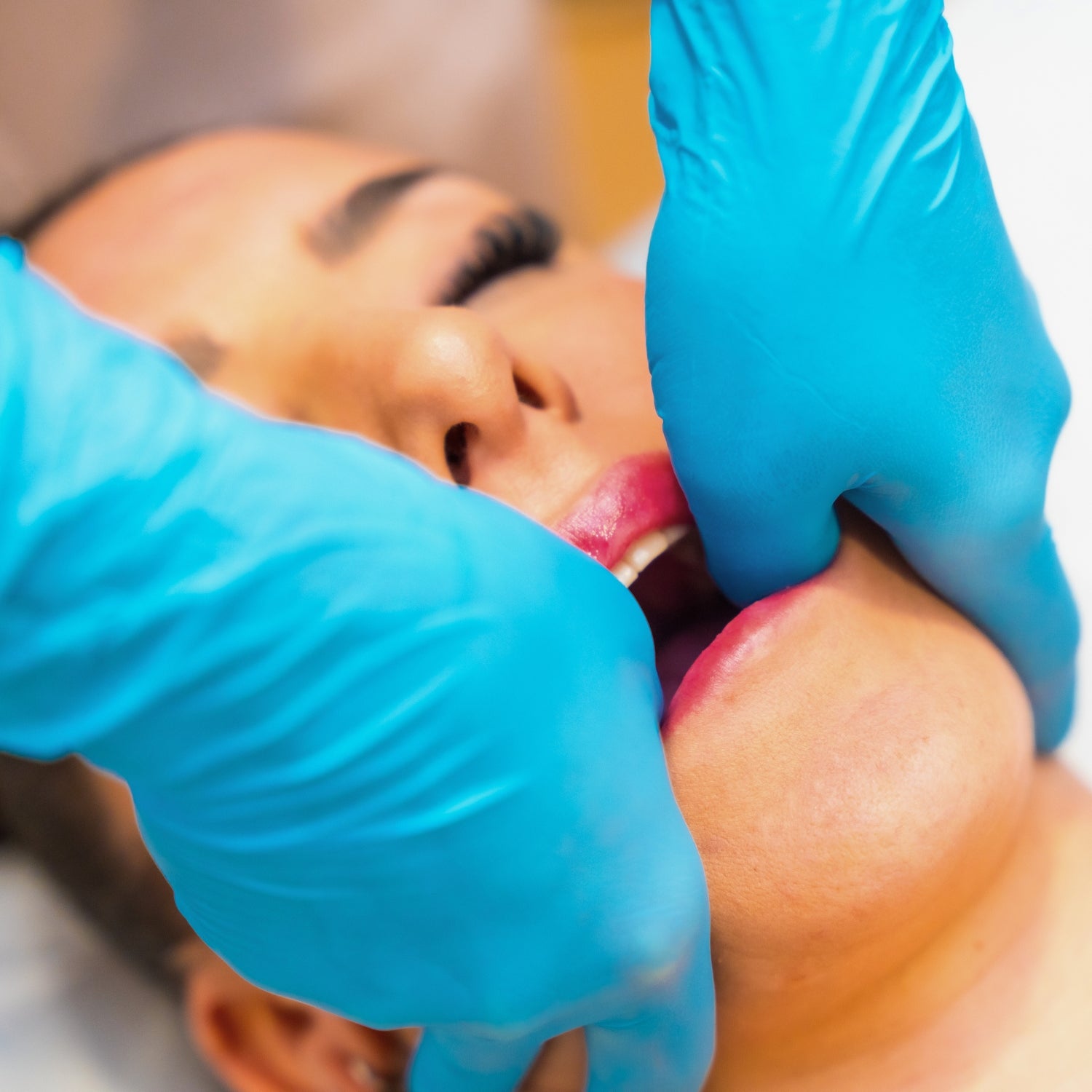 Toxina Botulínica | Tratamiento Bruxismo