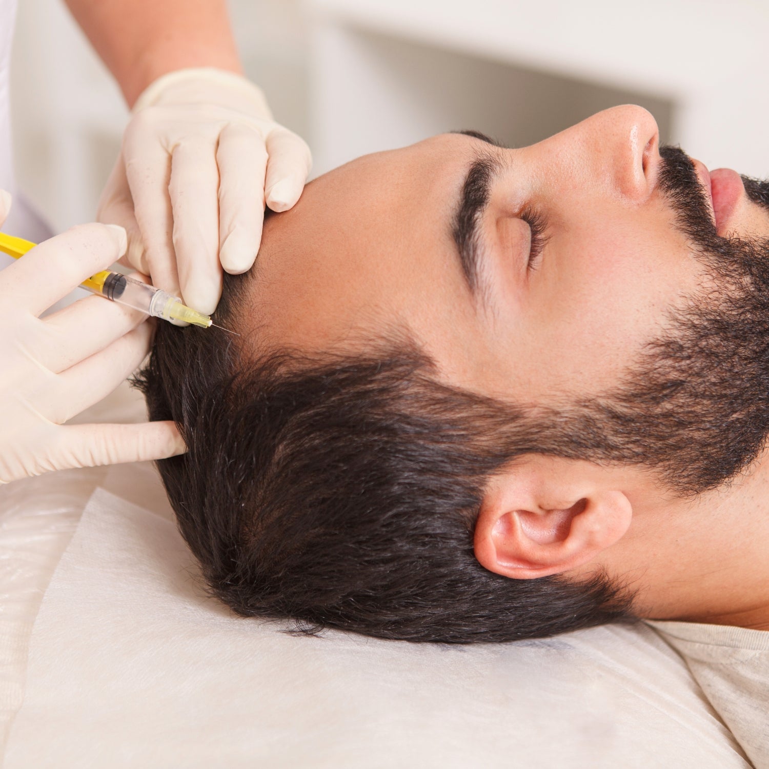 MICRONEEDLING ESTIMULACIÓN CAPILAR
