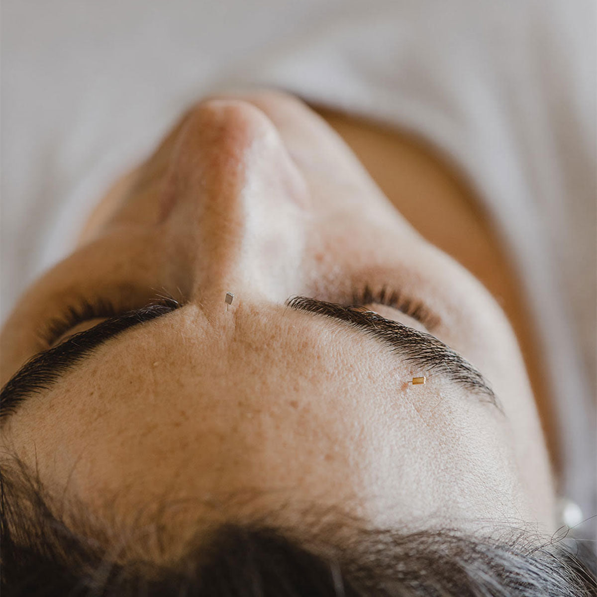 ACUPUNTURA FACIAL