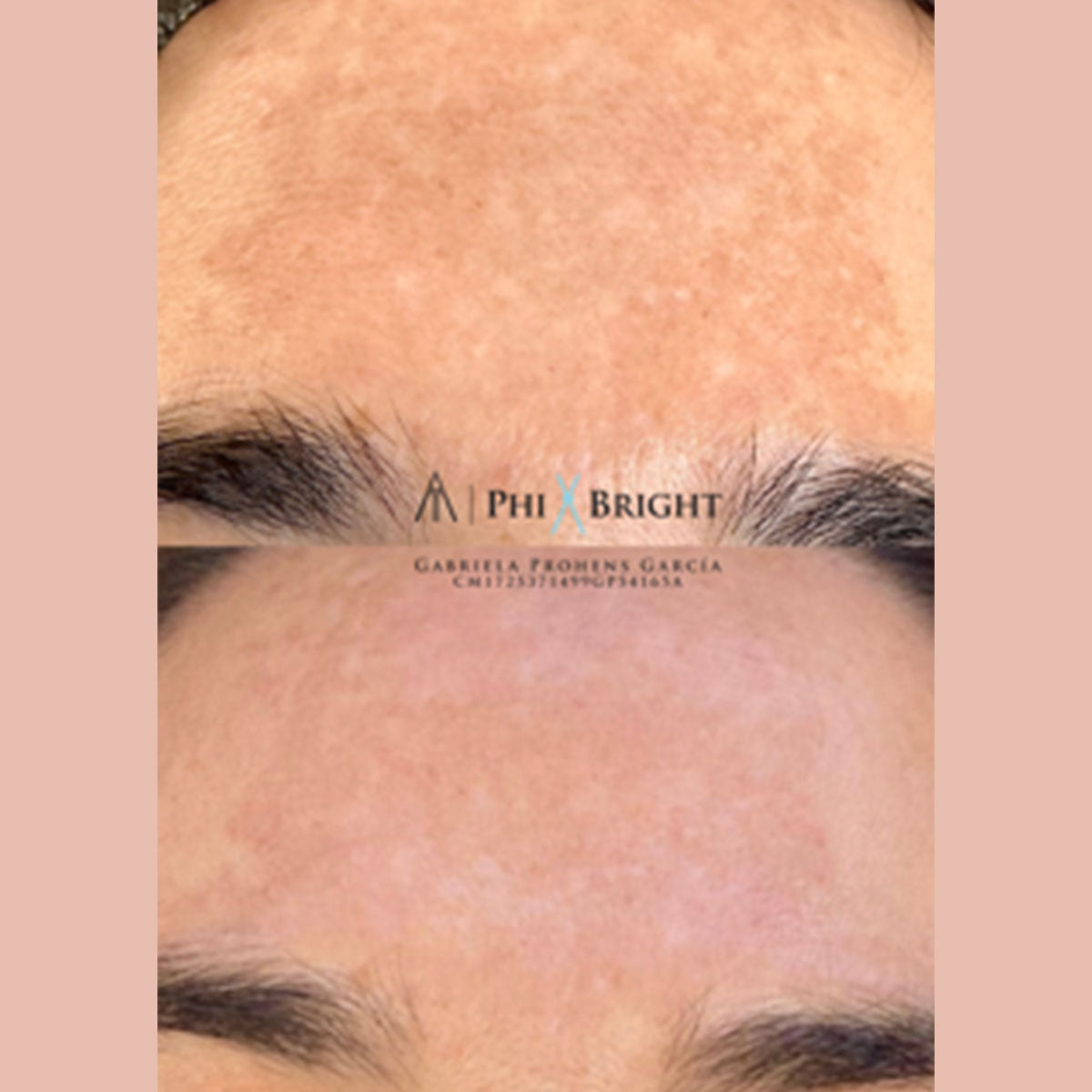MICRONEEDLING FACIAL CICATRICES O ESTRÍAS