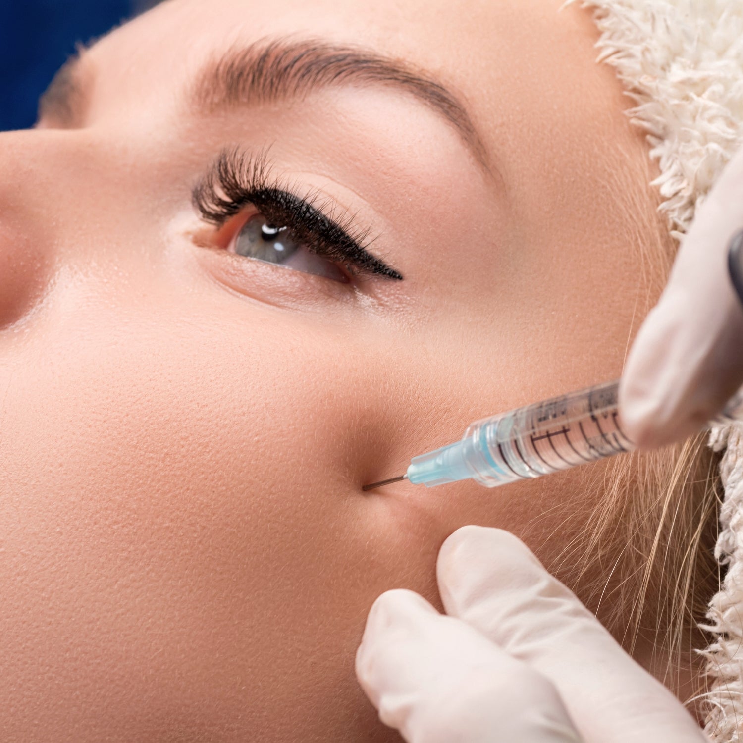 Ácido hialurónico | Pómulos