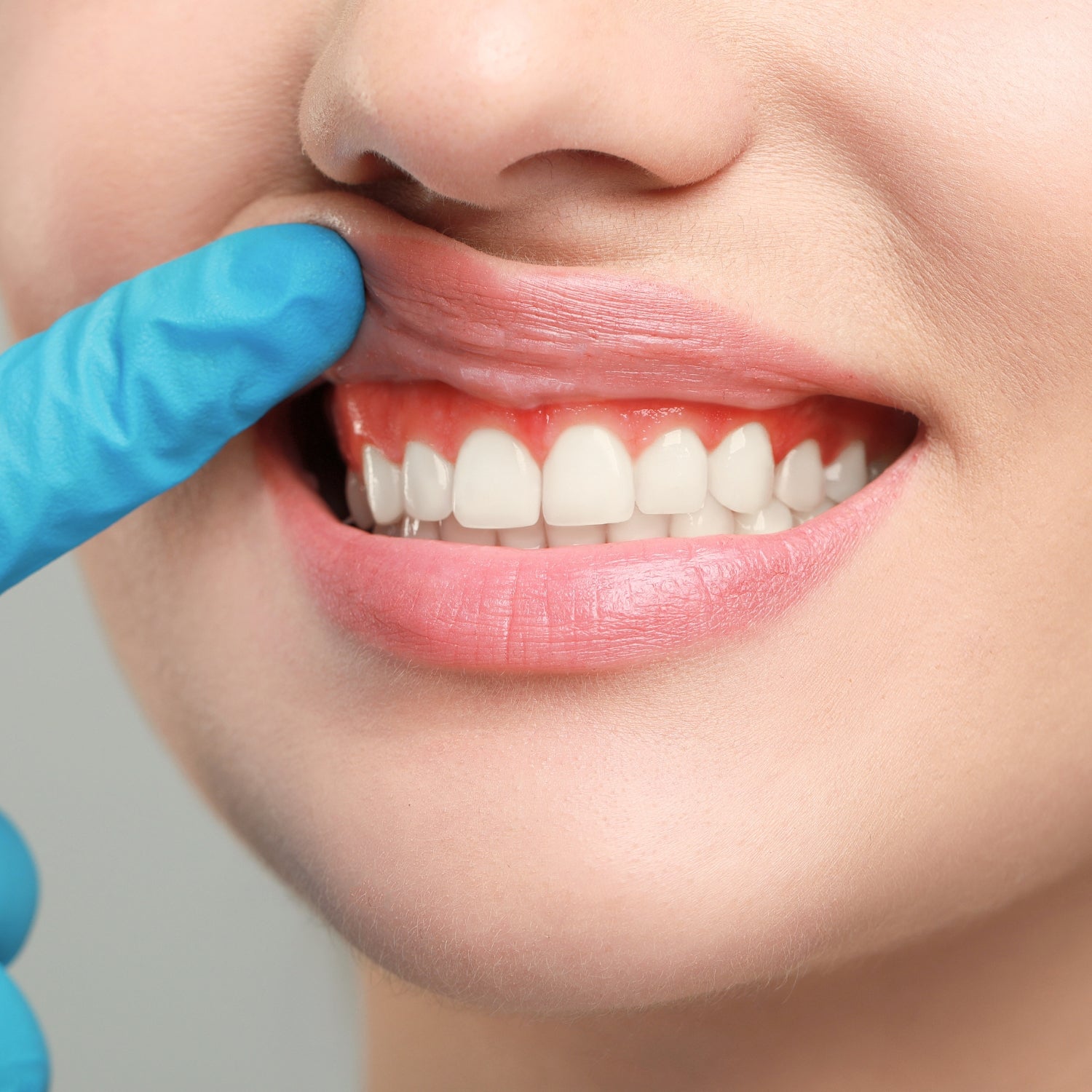 Toxina Botulínica | Sonrisa gingival