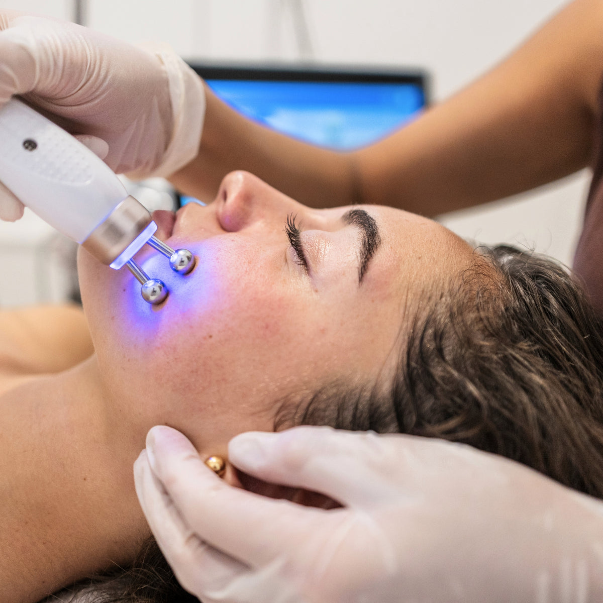 Reafirmación con Radio Frecuencia Facial